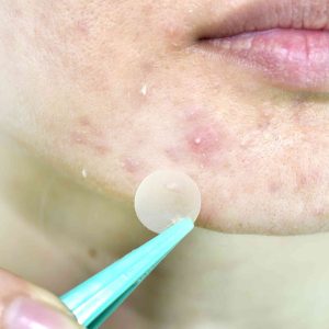 Hydrocolloid pimple patches
