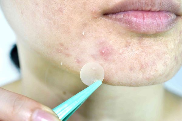 Hydrocolloid pimple patches
